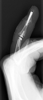 PIP arthroplasty; DIP fusion